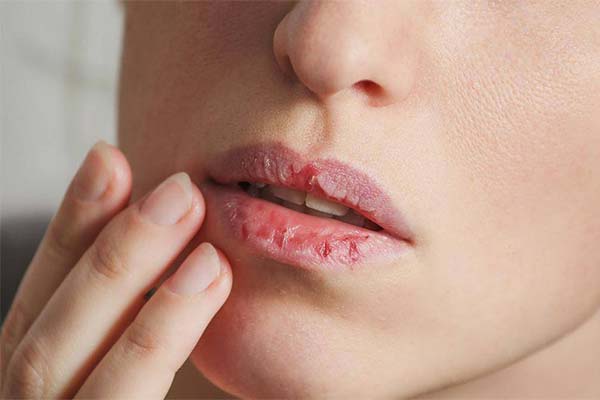 Welche Vitamine fehlen, wenn die Lippen rissig werden?